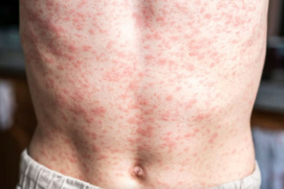 Aumentan muertes por sarampión en México; CDMX reporta primer deceso