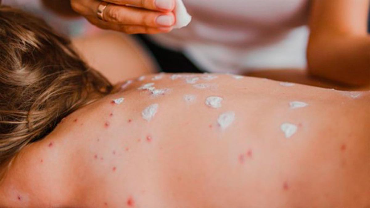 México suma 362 casos de sarampión; Ssa reporta una muerte por la enfermedad