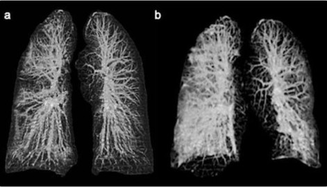 ¡Impactante! Así es como se ven unos pulmones con COVID-19