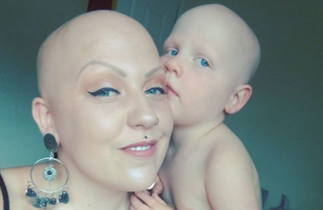 ¡Ser calva es hermoso!