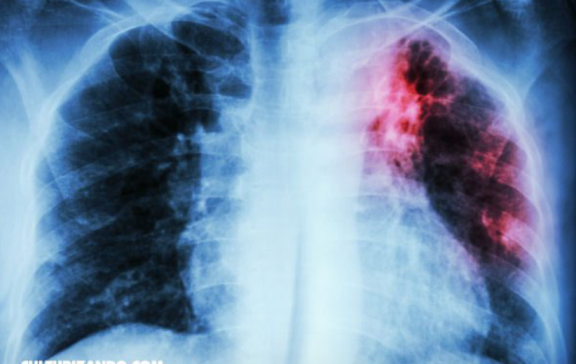 Detectan más casos de Tuberculosis en Nuevo Laredo