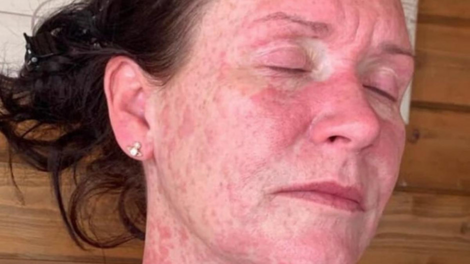 Mujer en Escocia sufre reacción alérgica tras ser vacunada con dosis de AstraZeneca