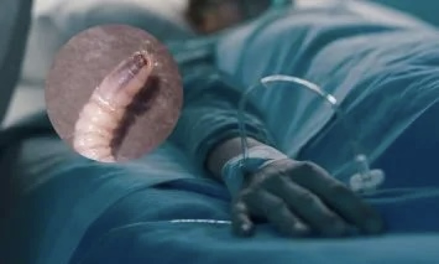 Confirman octavo caso de miasis por gusano barrenador en Yucatán; es el primero en Mérida