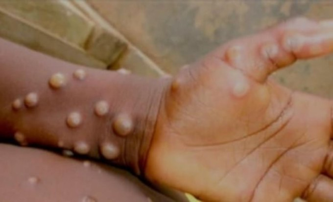 OMS declara nuevamente el mpox como una emergencia internacional de salud pública