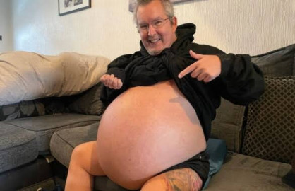 Operarán en RU al hombre con los riñones más grandes del mundo