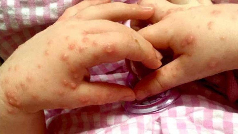 Descartan brote de coxsackie en Reynosa