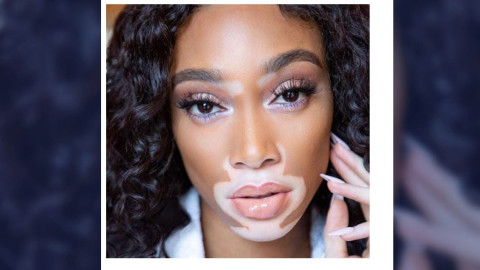 Winnie Harlow es elegida para desfilar en Victoria's Secret