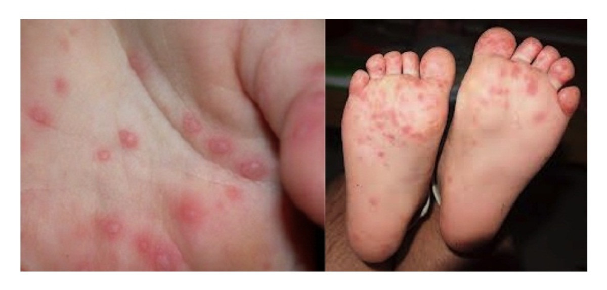 Registran aumento de coxsackie en Hidalgo