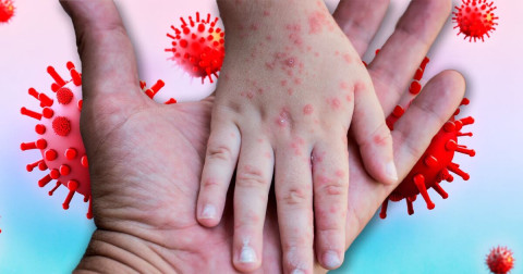 México registra 74 casos activos de sarampión; Salud refuerza vacunación y vigilancia epidemiológica