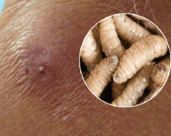 Confirma Salud primer caso de miasis por gusano barrenador en un humano en México