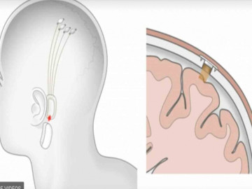 Elon Musk busca desarrollar chip para tratar autismo y esquizofrenia