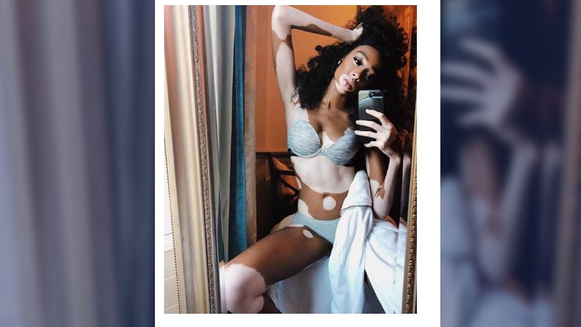 Winnie Harlow es elegida para desfilar en Victoria's Secret