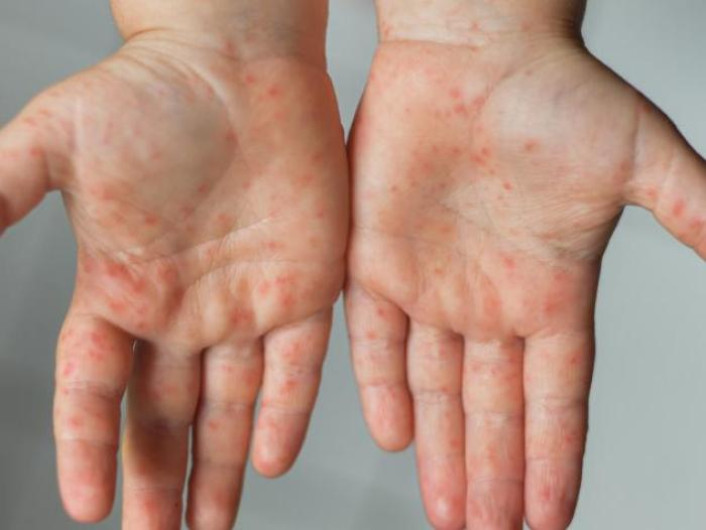 Anuncia EU que emergencia sanitaria por viruela del mono terminará en enero