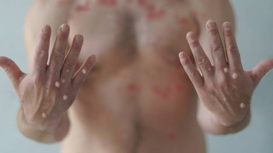  Ascienden a 9 los casos confirmados de viruela del mono en Honduras